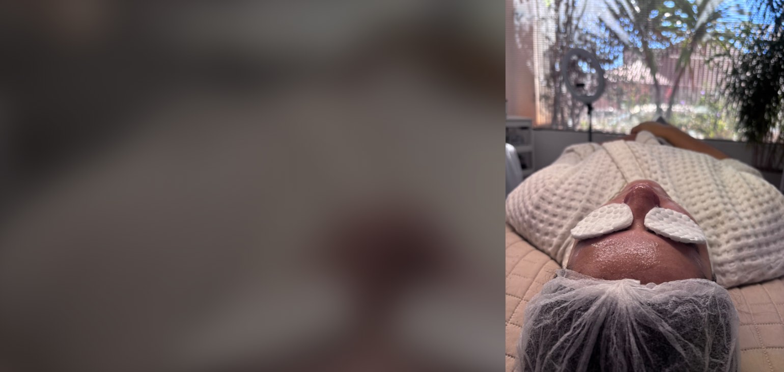 Cliente em limpeza de pele, com algodões sobre os olhos e a janela ao fundo